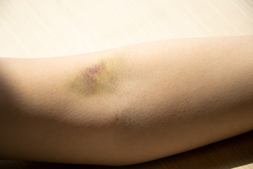 Fototapeta premium Bruise injury on the female arm background