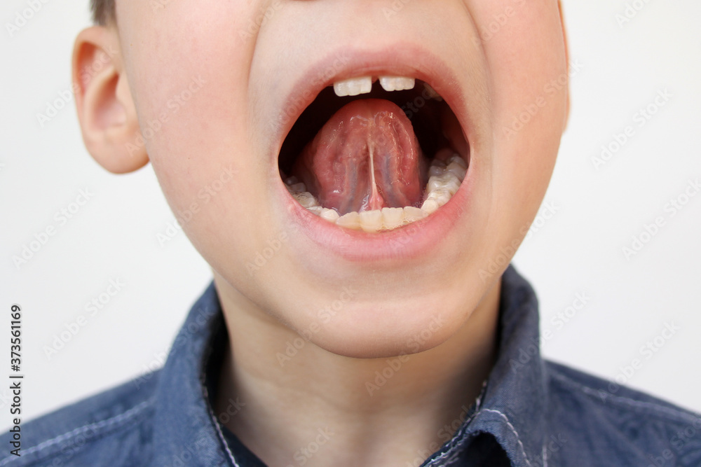 Poster boy, kid opened his mouth, oral cavity, close-up teeth, performs articulation exercises for the tongue, vocals, dental concept, speech therapy - Posters