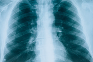 X-ray of lungs, fluorography. Medical scan of the lungs
