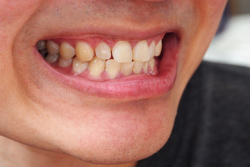 Young man smiling showing his yellow teeth and some plaque. Need to see dentist for teeth treatment...