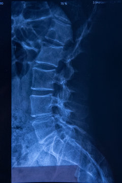 X-ray of human cervical spin. Lateral View. 