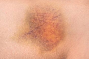 large bruise hematoma on the womans leg on the skin