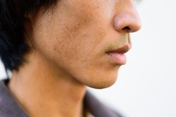 Obraz premium Closeup to Blemish on cheek of the man skin