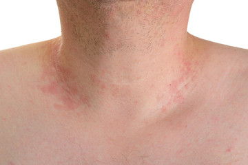 Hautausschlag Erythrasma Zwergflechte am Hals