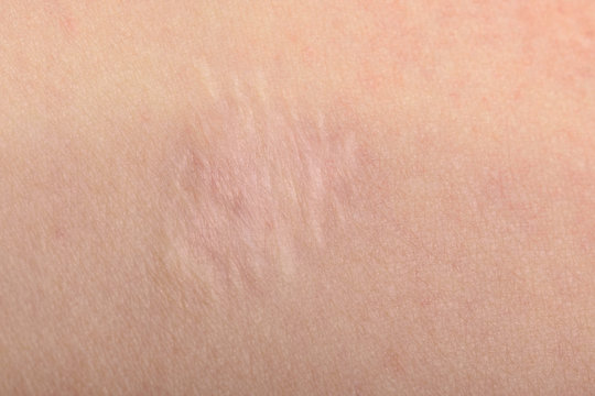 Vernarbung nach Muttermalentfernung