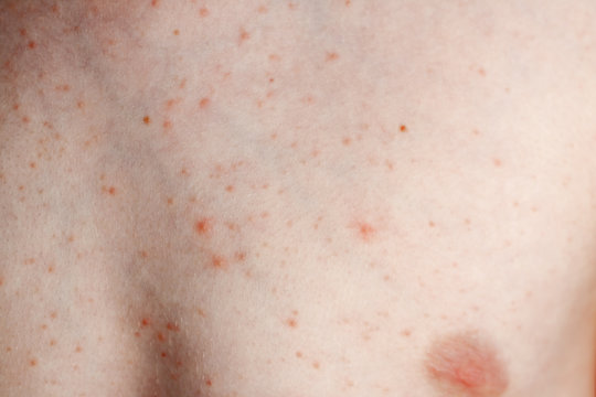 Close up image of a little boy's body suffering severe urticaria, nettle rash also called hives