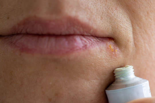 Middle aged woman Applying Ointment on corner of her mouth with Herpes Labialis.