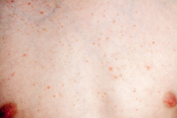 Close up image of a little boy's body suffering severe urticaria, nettle rash also called hives