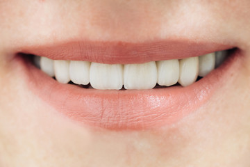 Beautiful female teeth macro zirconium. Closeup smile photo with zirconium artificial teeth. Zirconia bridge with porcelain.