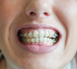 Obraz premium mujer joven muestra su bonita dentadura con un corrector dental para alinear y obtener una sonrisa perfecta