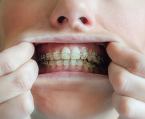 mujer joven muestra su bonita dentadura con un corrector dental para alinear y obtener una sonrisa...