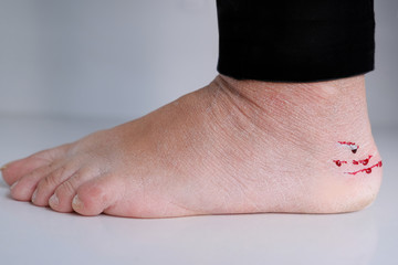 bare foot of an adult woman with wrinkled dry skin and wounds with blood drops, scratches from the...