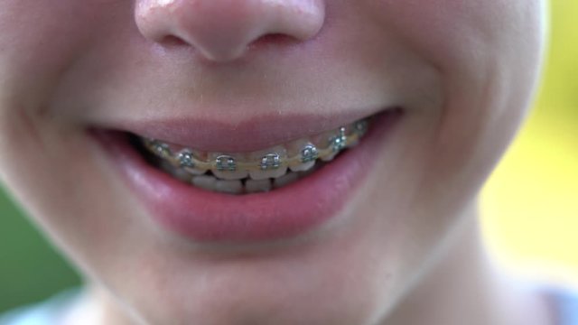 Close up view 4k video of smiling mouth of young white kid with overbite teeth with fixed metal modern braces construction on teeth.