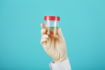 A container for biomaterial with a urine analysis in the hand of a doctor in a white rubber glove...