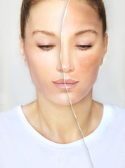 Dark spots, freckles,hyperpigmentation(melasma or chloasma),concept- skin lightening, skin...