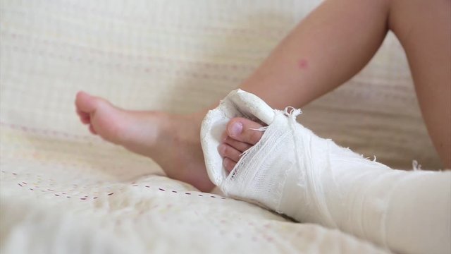 broken leg. Close-up of the cast on the feet. exercises to repair and strengthen muscles. damage to the bones. medical care of a surgeon in the emergency room