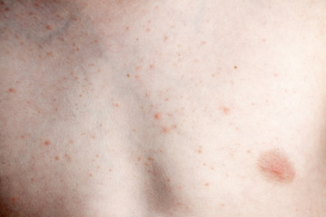 Close up image of a little boy's body suffering severe urticaria, nettle rash also called hives