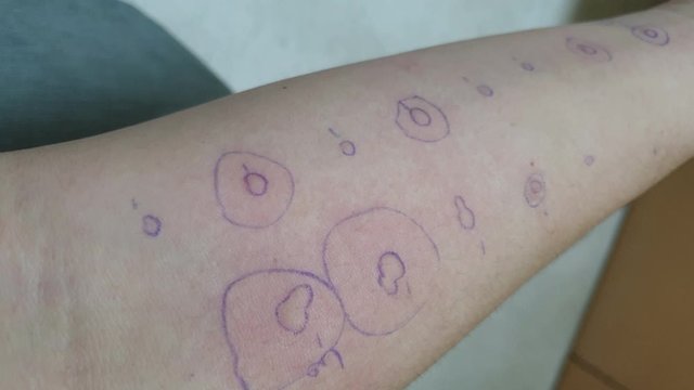 aeroallergen test rash reaction skin prick test of mite pollen cat and dog allergy