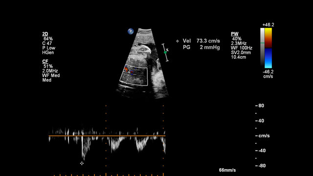 Ultrasound screen with fetal echocardiography.