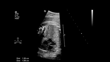 Ultrasound screen with fetal echocardiography.