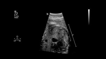 Ultrasound screen with fetal echocardiography.