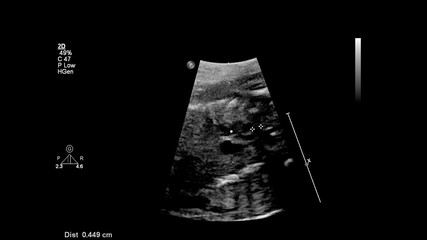 Ultrasound screen with fetal echocardiography.