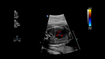 Ultrasound screen with fetal echocardiography.