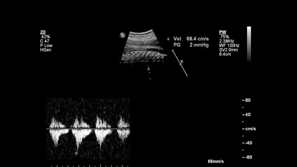 Ultrasound screen with fetal echocardiography.