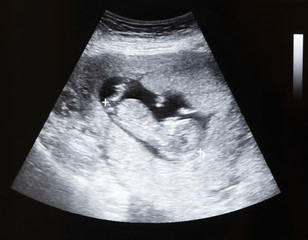 Ultrasound of baby in pregnant woman
