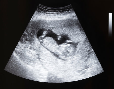 Ultrasound of baby in pregnant woman