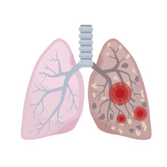 Human lungs, respiratory system. A healthy and sick lung. Lung damage. Vector illustration