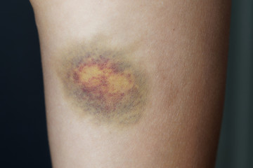 Close up. A large bruise on a woman's leg. - obrazy, fototapety, plakaty