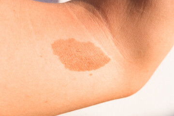 Fototapeta premium A large mole, birthmark on the skin of the arm of a young man.