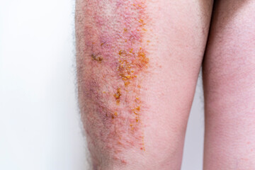 Fototapeta premium 膿の出ている重度の湿疹
