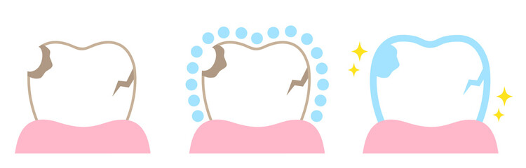 歯　ポリリン酸　治療