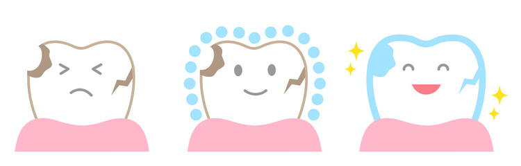 かわいい歯　ポリリン酸　治療