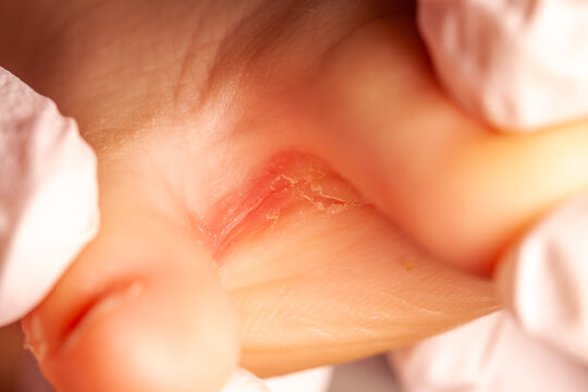 Doctor little girl's foot with fungus infection