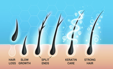 Different hair problems and deep salon treatment vector illustrations set, macro view of balding scalp skin and follicles