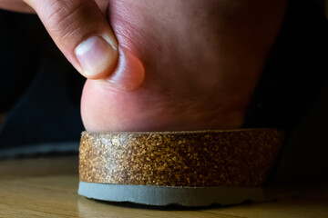 Terrible bladder on the heel. Hand touching painful blister skin on the feet. Painful wound with...