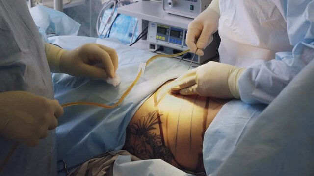close-up. abdominal liposuction. surgery. the surgeon pumps out the fat through a special tube. operating room and intensive care in the hospital