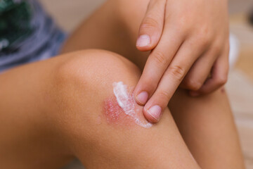 The child smears cream on the skin irritation. Care of the skin.