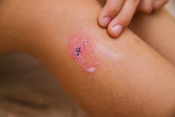 Fototapeta premium The child smears cream on the damaged skin on the leg. Dry skin and irritation. Allergic reactions.