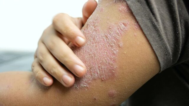 Hands of man using laptop computer and scratching to arm skin rash psoriasis