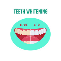 Before and after teeth whitening. Vector illustration isolated on a white background