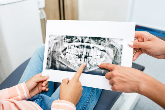 x-ray of children's teeth. Milk and molars are visible in the picture, close-up