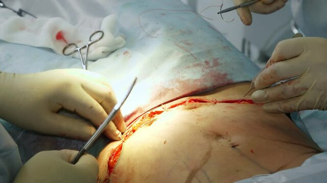 Plastic surgery. close-up. the surgeon sutures a large incision in patient's abdomen after abdominal liposuction.