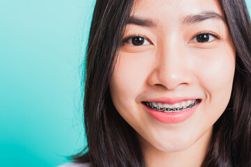 Closeup teen Asian beautiful young woman smile have dental braces on teeth laughing, studio shot isolated on a blue background, medicine and dentistry female mouth concept