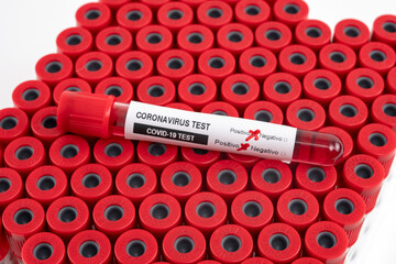 Blood test samples for presence of coronavirus (COVID-19) tube containing a blood sample that has tested positive for coronavirus.