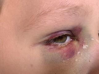 Fototapeta na wymiar Bruise on the eye of a boy, close-up. A tumor under the eye of a teenager. Blue discoloration and himatoma on the face of a child. Concept: trauma, bodily injury.