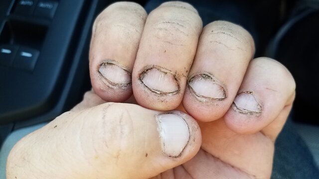 Bitten And Dirty Fingernails On Hand In Car